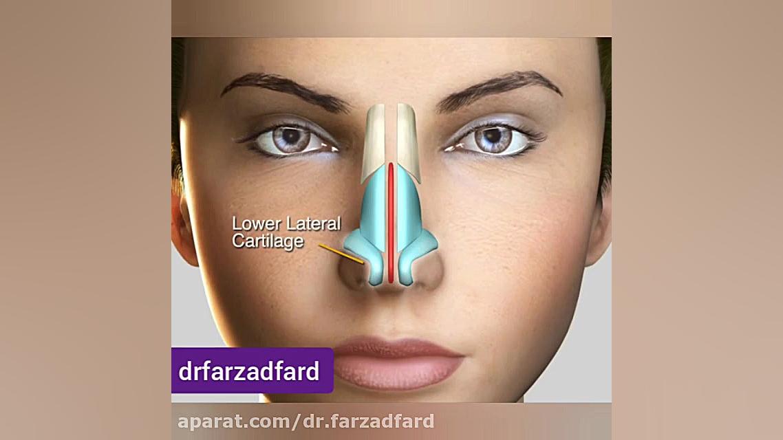 نوک بینی برجسته در جراحی زیبایی بینی دکتر اسماعیل فرزاد فرد - فوق تخصص پلاستیک
