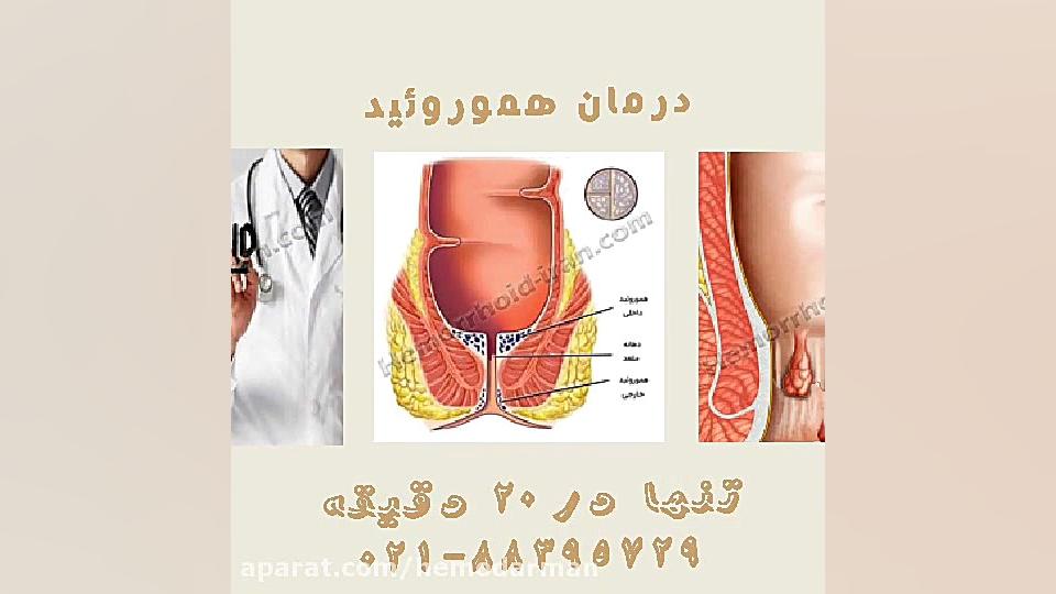 درمان بواسیر به صورت سرپایی توسط دکتر تهرانی لیزر مو