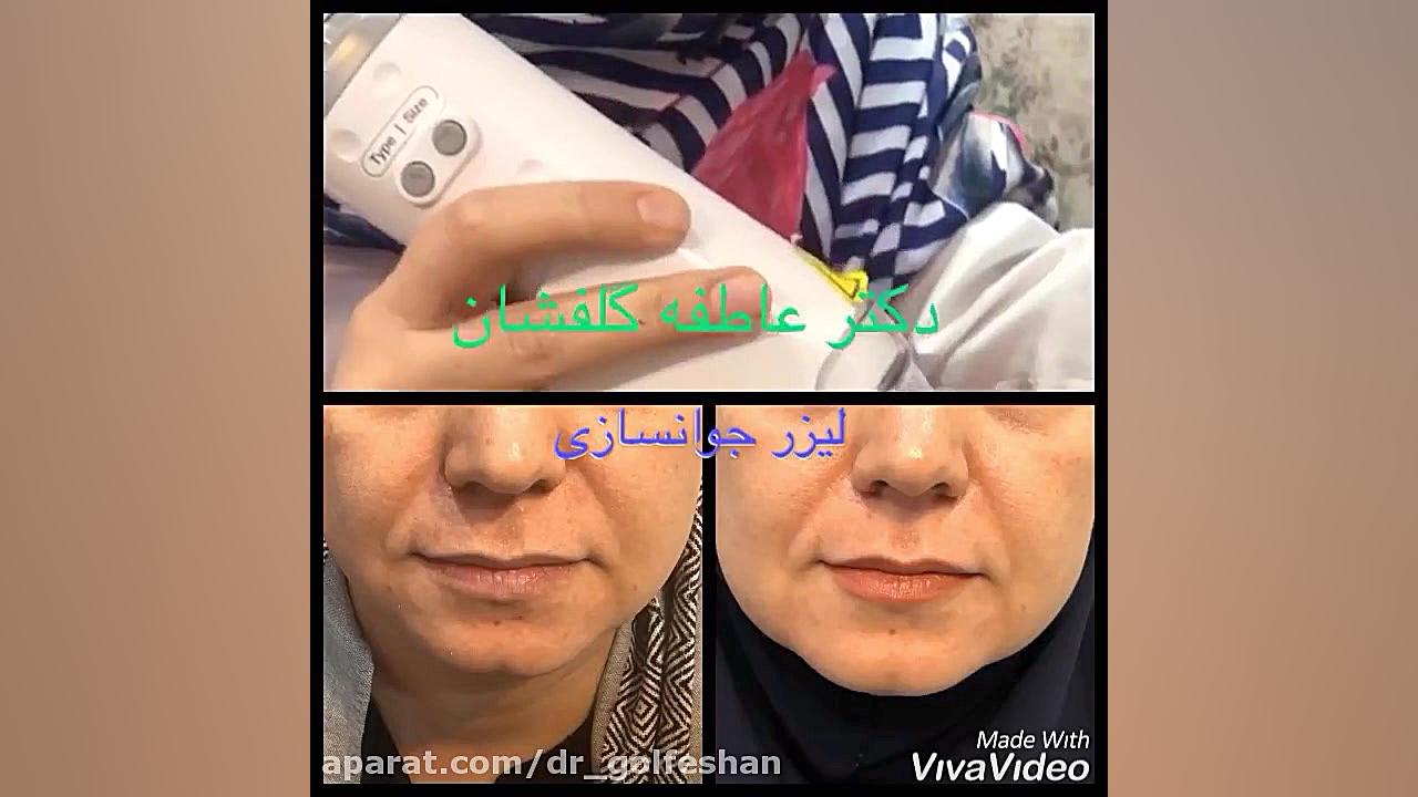 لیزر جوانسازی صورت ( شرق تهران،پاسداران، نارمک،تهرانپارس) دکتر عاطفه گلفشان، متخصص پوست مو و لیزر درمانی
