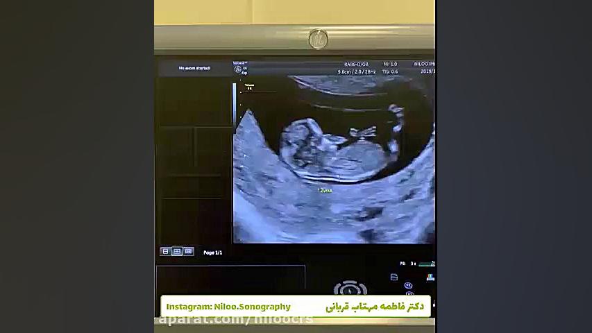 شرايط استاندارد قرارگيری جنين برای غربالگری اول سونوگرافی نیلو دکتر فاطمه مهتاب قربانی