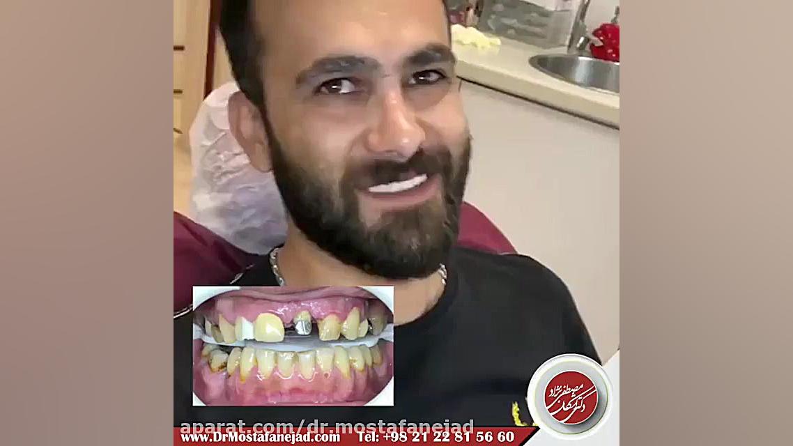 اصلاح طرح لبخند | دکتر اشکان مصطفی نژاد تست لوسمی باقی‌مانده