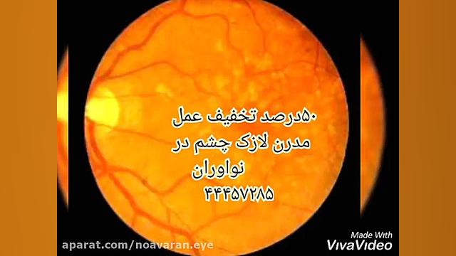 تخریب لکه ی زرد شایع ترین دلیل کاهش بینایی ناشی از افزایش سن اصلاح طرح لبخند