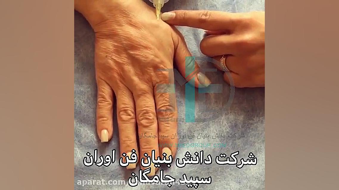 فیلم جوانسازی پوست دست با کربوکسی تراپی FEV1