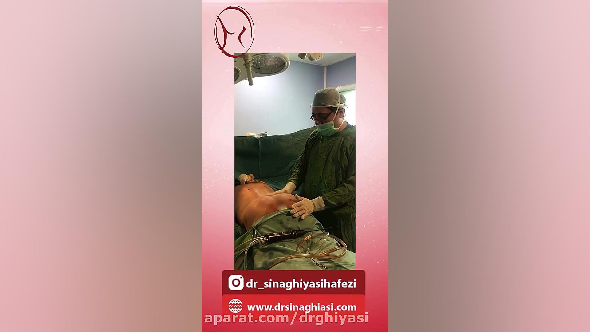 پیکر تراشی و تزریق چربی در باسن دکتر سینا غیاثی حافظی