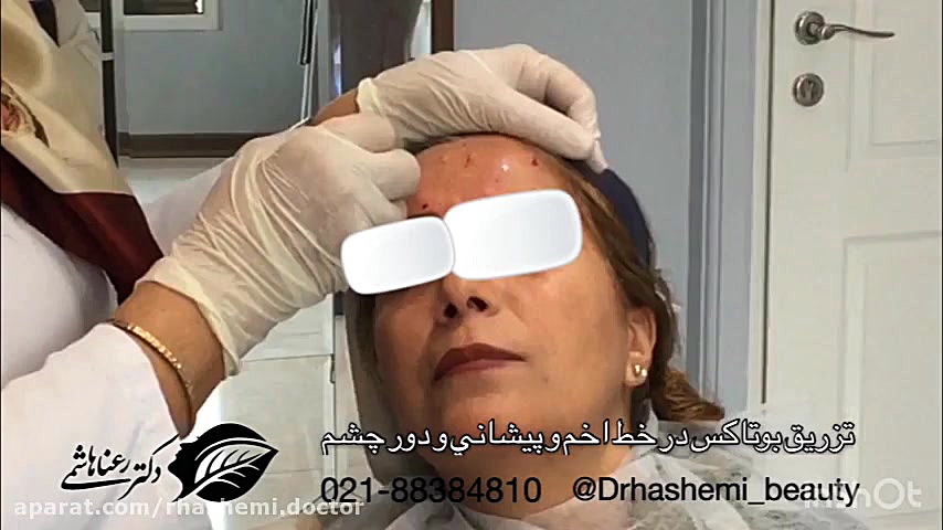 تزریق بوتاکس دور چشم و خط اخم Meta-Transcriptomics