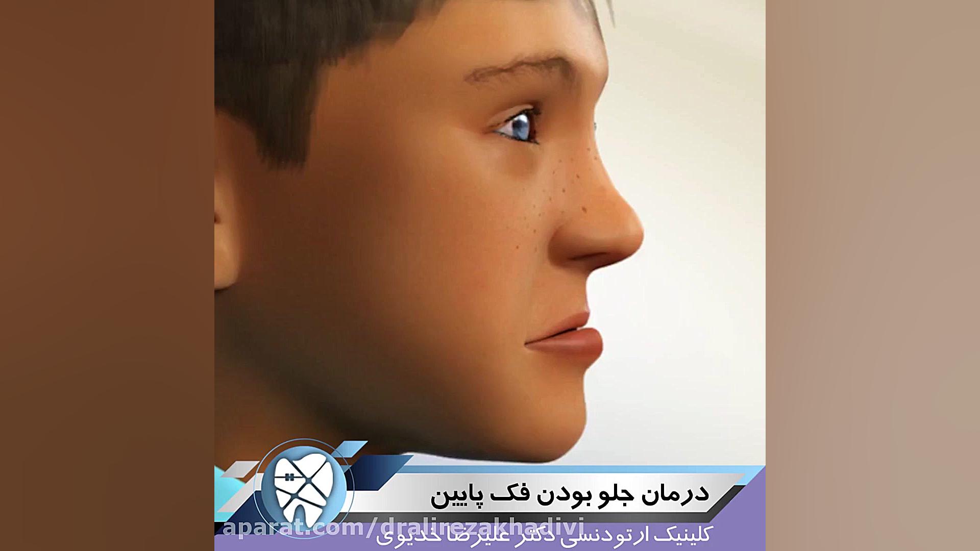 درمان جلوبودن فک پایین دکتر علیرضا خدیوی