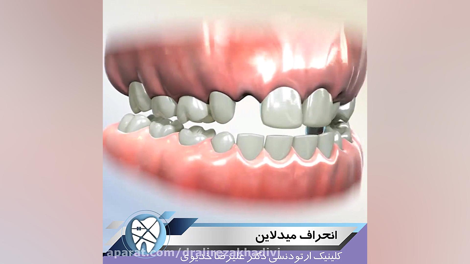 انحراف میدلاین دکتر علیرضا خدیوی