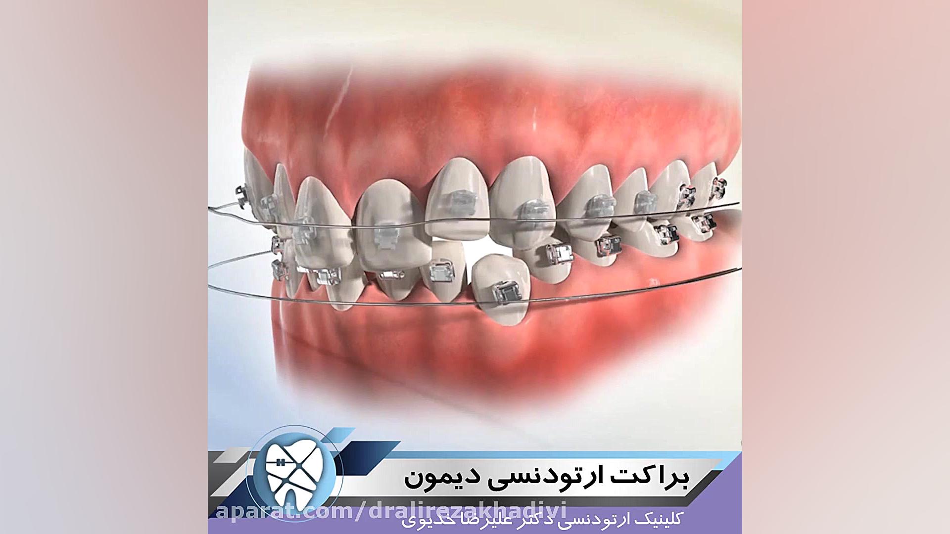 براکت ارتودنسی دیمون دکتر علیرضا خدیوی