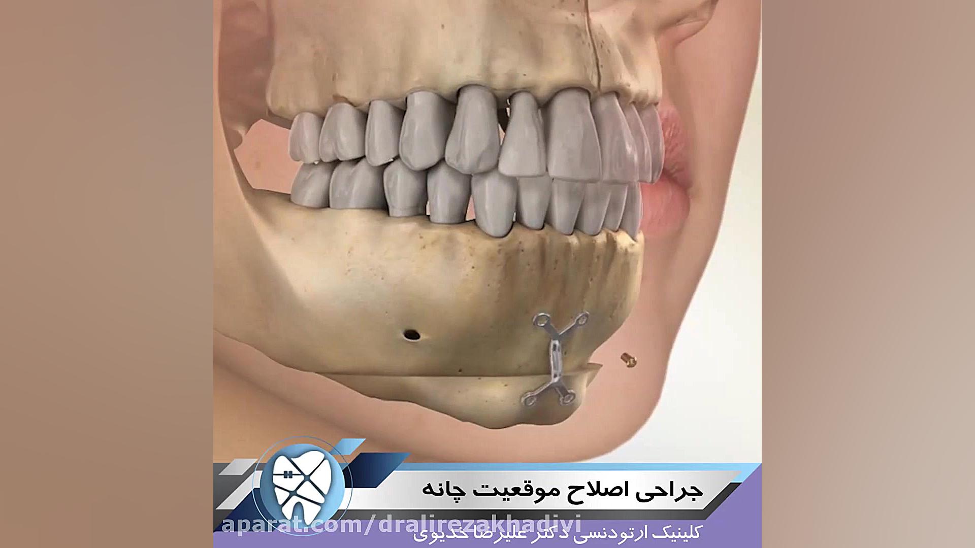 جراحی اصلاح موقعیت چانه دکتر علیرضا خدیوی