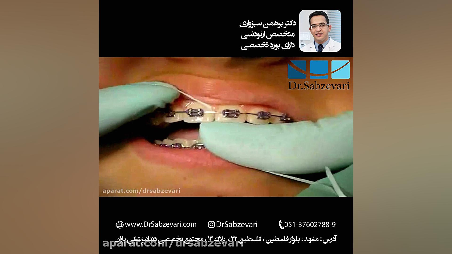 بهداشت دهان در ارتودنسی ثابت - 1 دکتر برهمن سبزواری - متخصص ارتودنسی - مشهد