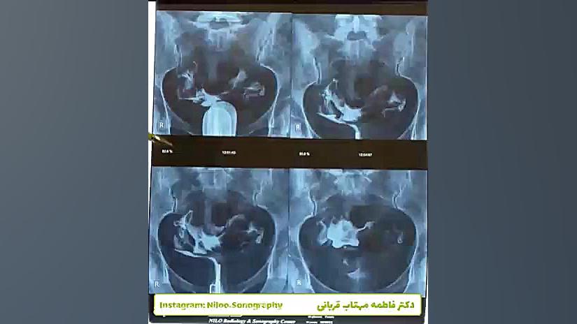 عکس رنگی رحم - هیستروگرافی سونوگرافی نیلو دکتر فاطمه مهتاب قربانی