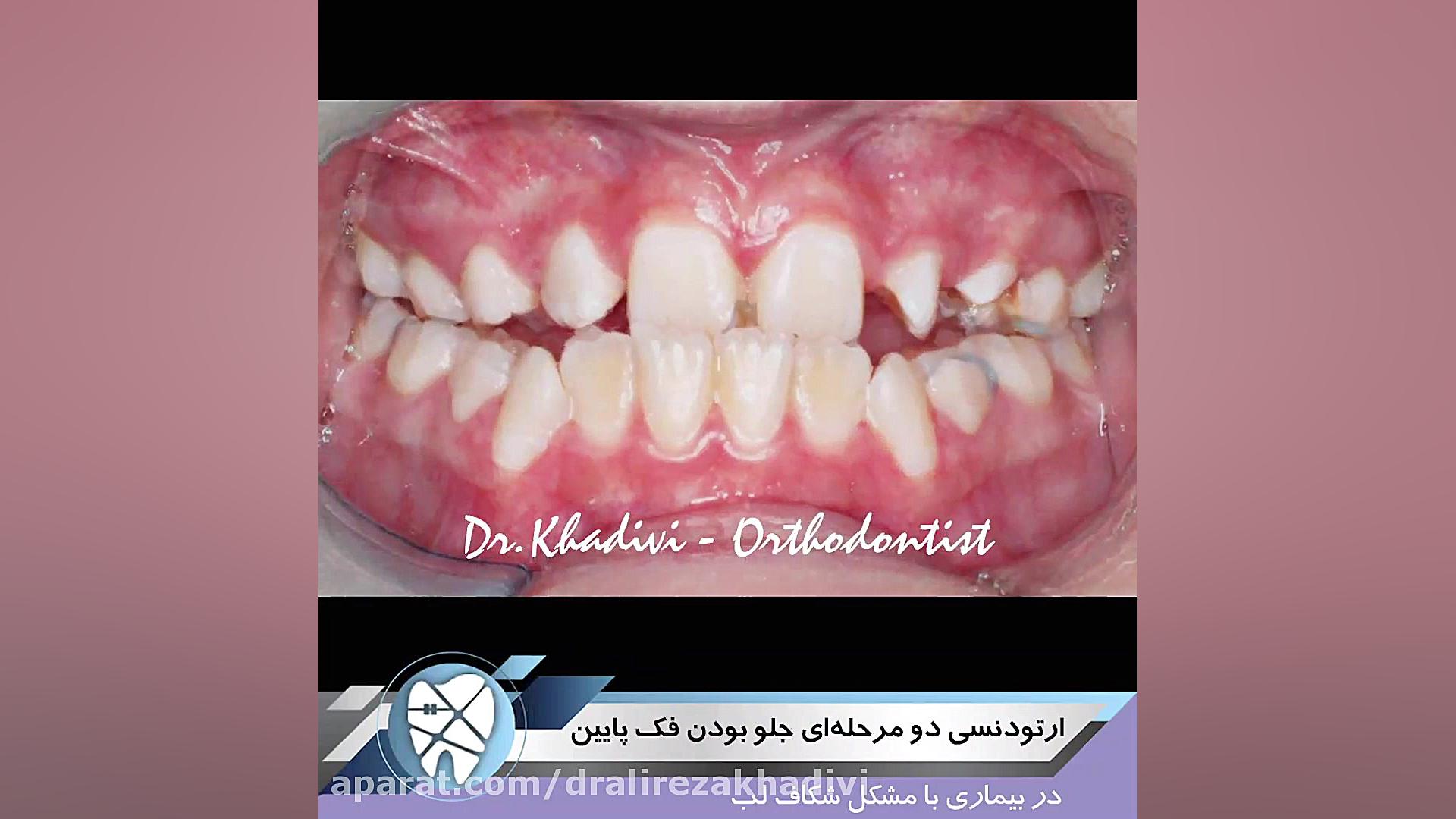 ارتودنسی دو محله ای جلو بودن فک پایین دکتر علیرضا خدیوی