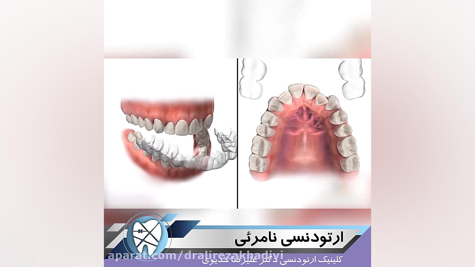 ارتودنسی نامرئی دکتر علیرضا خدیوی