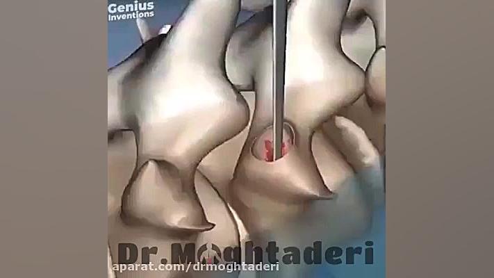 درمان جدید در اصلاح انحراف جانبی ستون فقرات (اسکولیوز) دکتر علیرضا مقتدری | متخصص طب فیزیکی