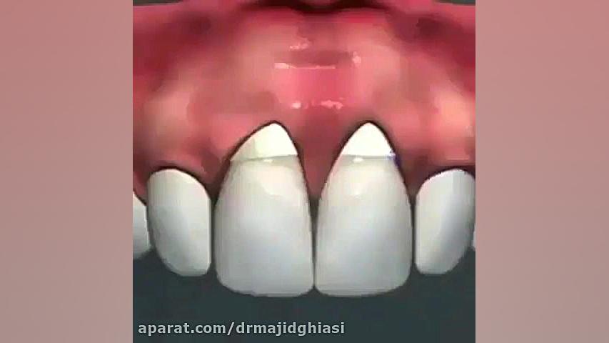 اصلاح طرح لبخند-دکترمجیدقیاسی دندانپزشک زیبایی مشهد دکترمجیدقیاسی
