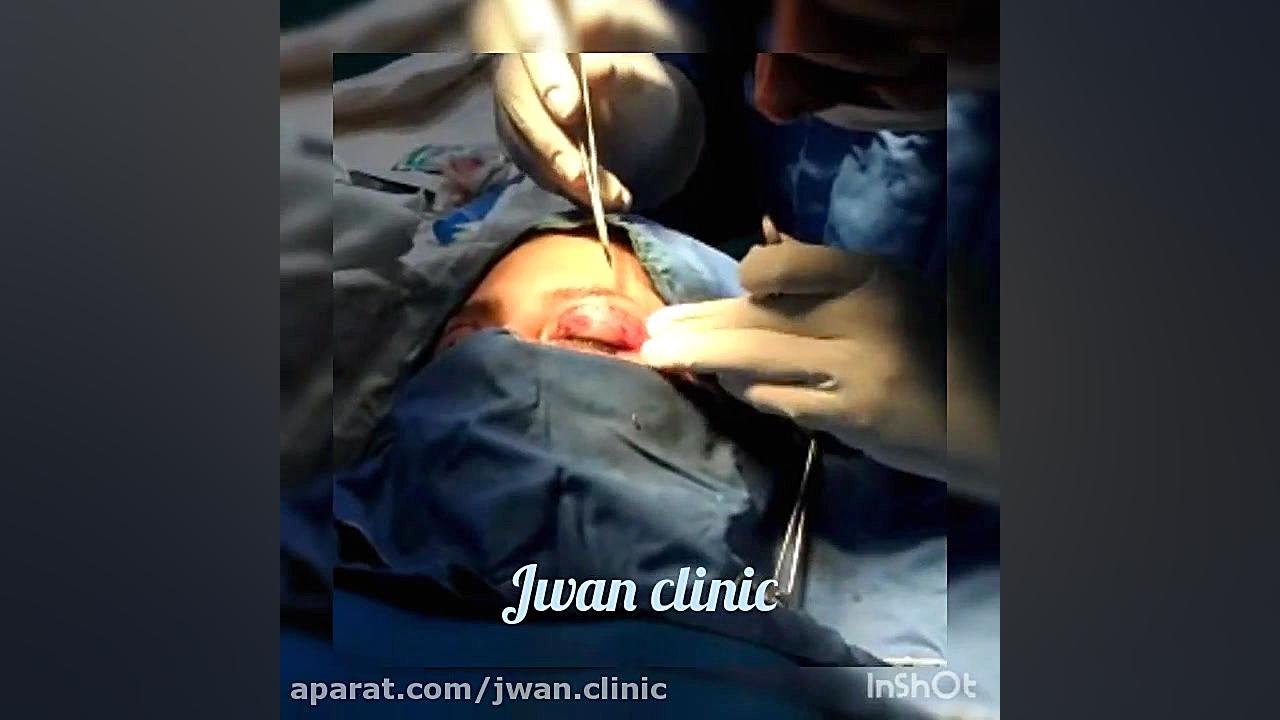 انجام عمل بلفاروپلاستی (جراحی زیبایی پلک) توسط دکتر سید محمد سالار ظاهریانی سنسور فشار اینتراوسکولار