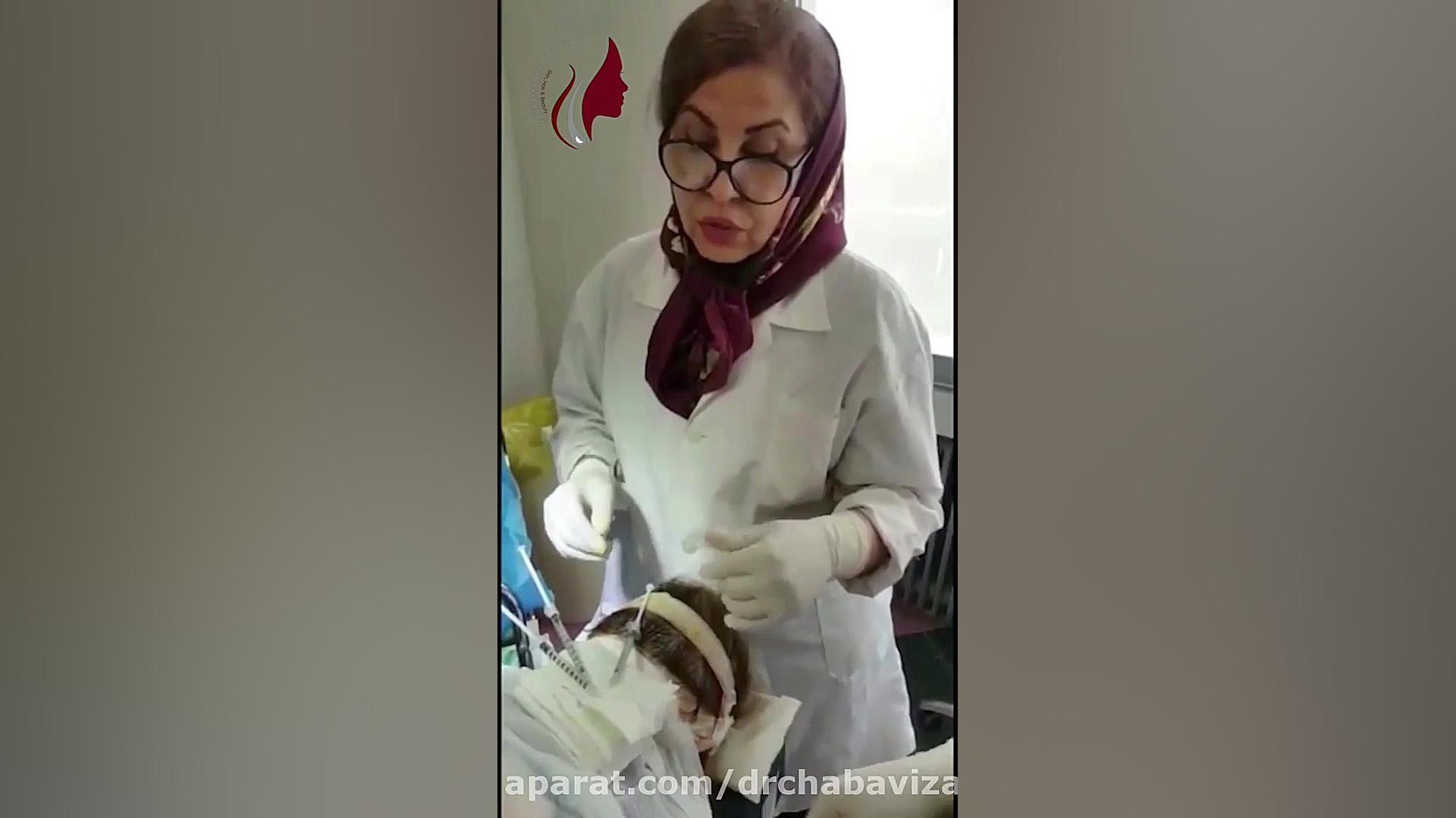 کاشت موی سر خانم ها- دکترچعباوی زاده دکتر صفیه چعباوی زاده