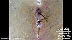 درمان کیست مویی بدون جراحی در...