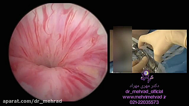 درمان نوین بی اختیاری ادراری به صورت سرپایی در مطب دکتر مهراد پاکسازی پوست