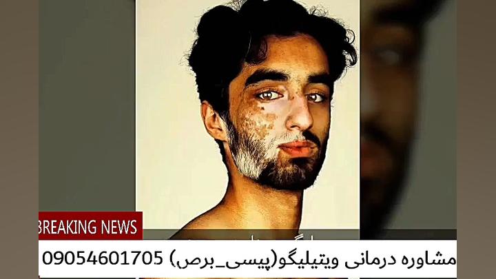 پیسی_ویتیلیگو درمان قطعی دارد برداشتن خال گوشتی