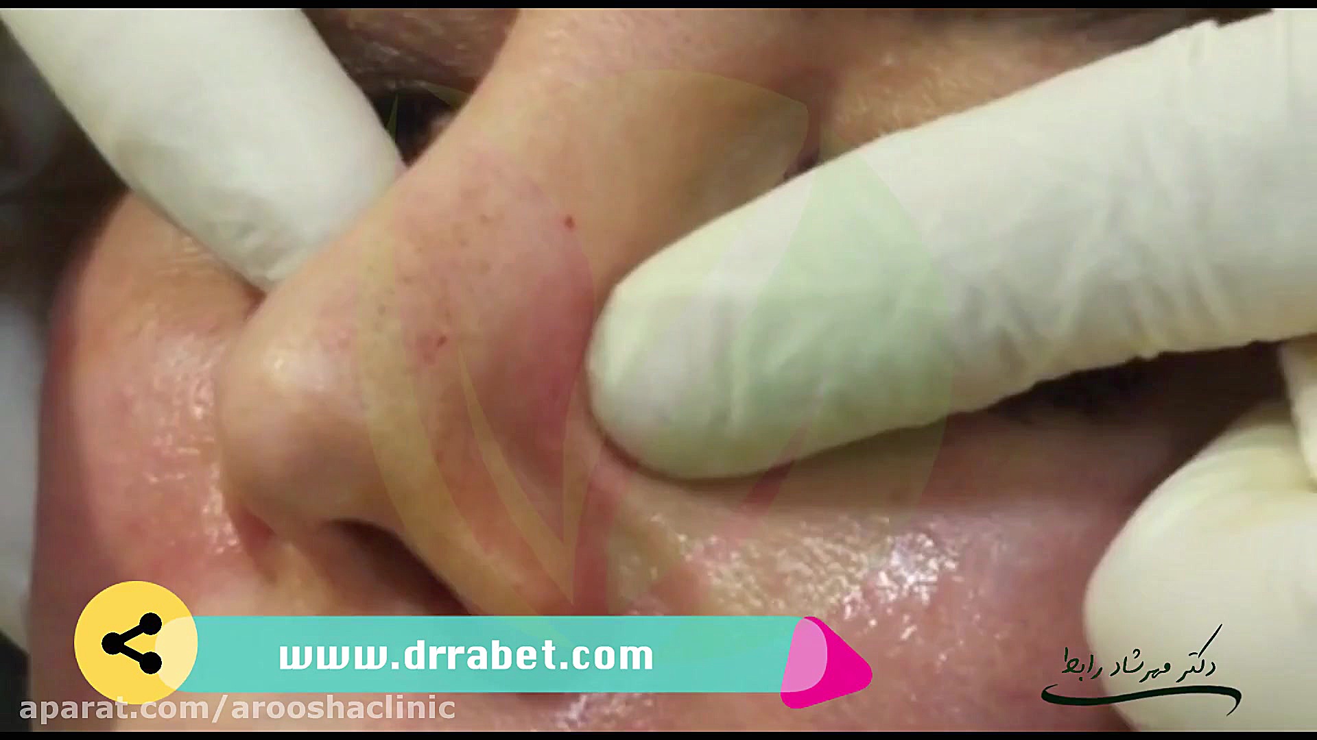 اصلاح فرم بینی کلینیک زیبائی دکتر مهرشاد رابط