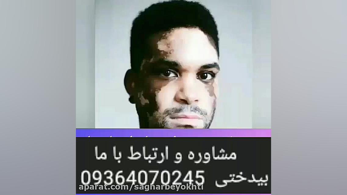 ایا هر لکه سفیدی ویتیلیگو_پیسی است؟ چالش جدید