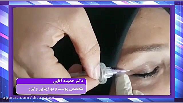 کربوکسی تراپی دور چشم بیماری پیرفیریک نوروپاتی