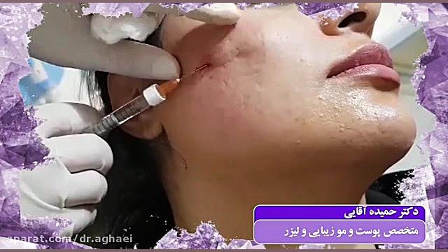تزریق ژل گونه با کانولا دکتر حمیده آقایی