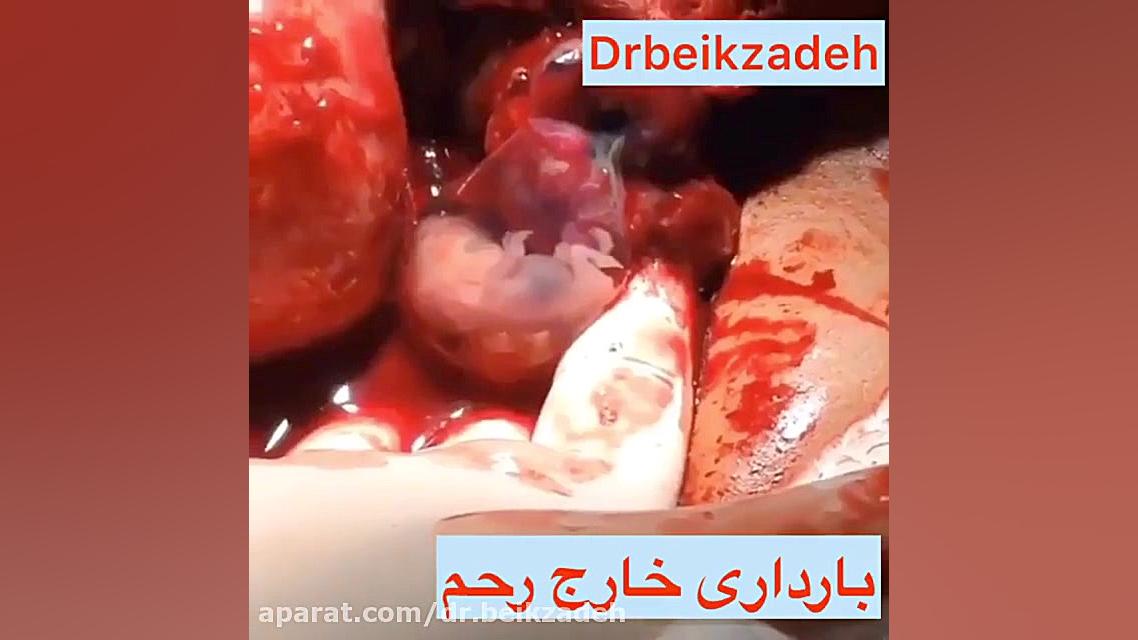 ویدیویی از بارداری خارج از رحم.دکتر بیک زاده دکتر مژگان بیک زاده ( جراح و متخصص زنان و زایمان)