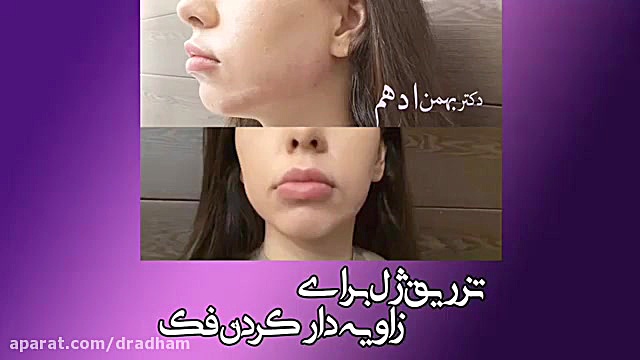 تزریق ژل برای زاویه دار کردن فک اکستنشن تاج دندان