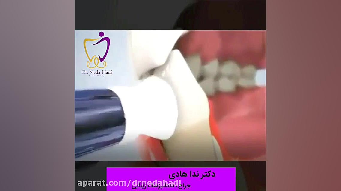 جرم گیری دندان دکتر ندا هادی-دندانپزشک زیبایی