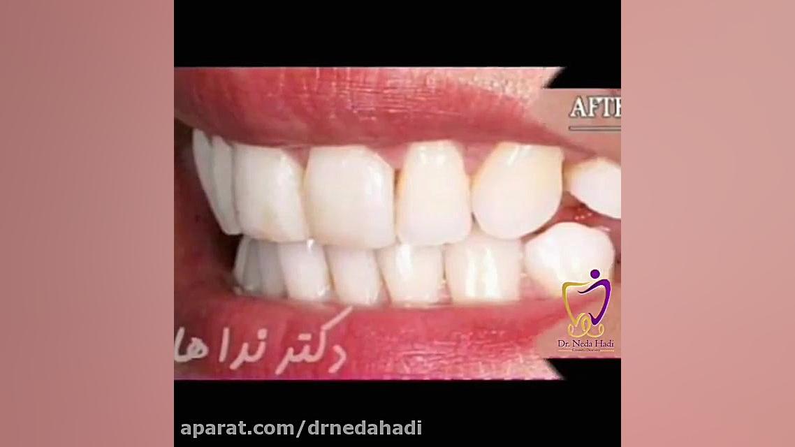 لمینت دندان دکتر ندا هادی-دندانپزشک زیبایی