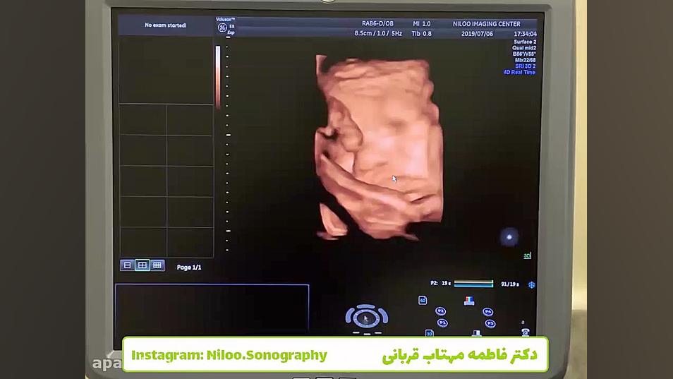 تخمینی بودن وزن جنین سونوگرافی نیلو دکتر فاطمه مهتاب قربانی