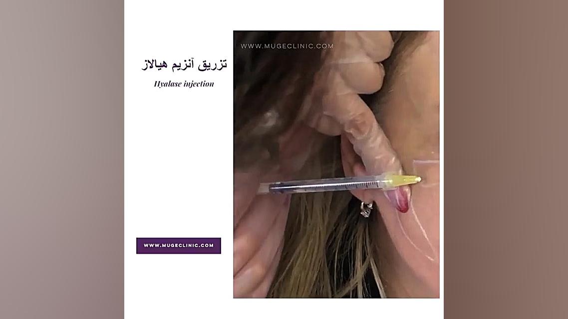 از بین بردن ژل با تزریق آنزیم -موگه کلینیک کلینیک مو