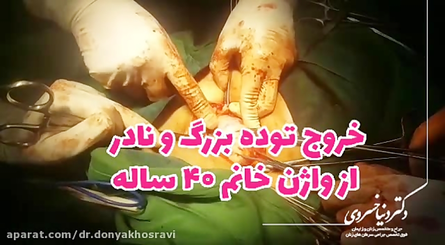 خروج توده بزرگ و نادر ، از واژن خانم ۴۰ ساله