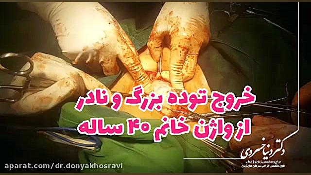 خروج توده بزرگ و نادر ، از واژن خانم ۴۰ ساله دکتر دنیا خسروی