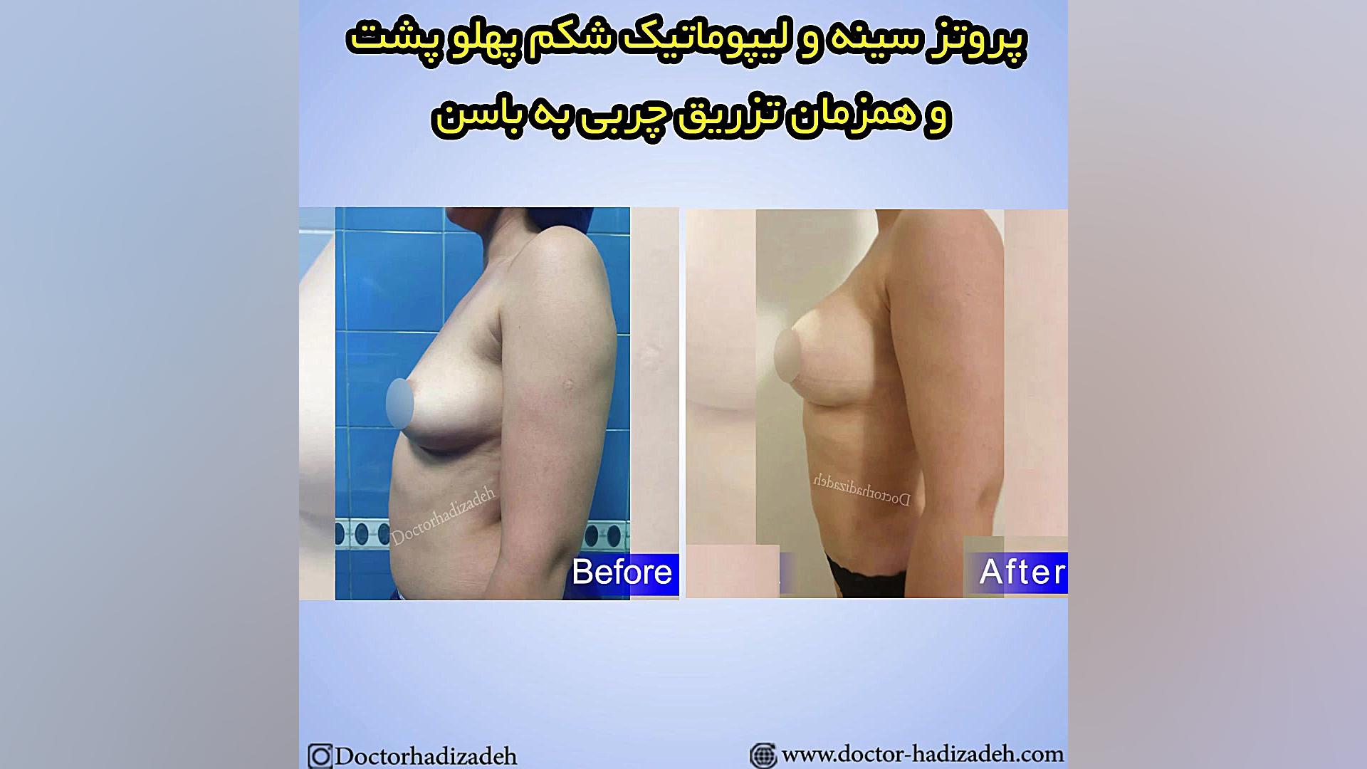 فیلم پروتز سینه ، لیپوماتیک شکم ، تزریق چربی به باسن بایوفیزیک پزشکی