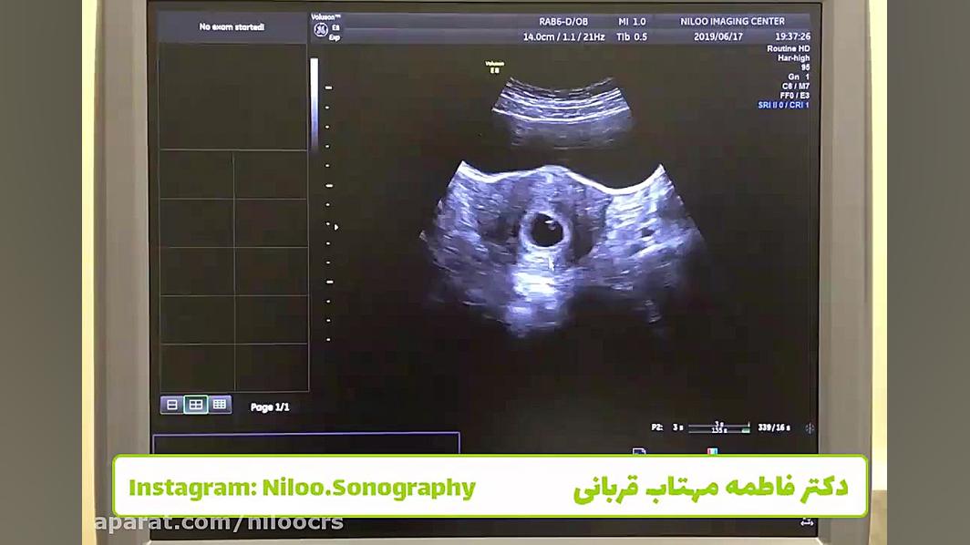 آنومالی های شکل رحم - رحم دو شاخ سونوگرافی نیلو دکتر فاطمه مهتاب قربانی