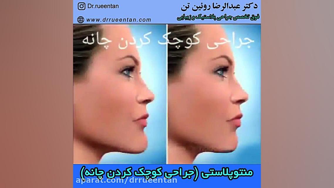 منتوپلاستی (جراحی کوچک کردن چانه) دکتر عبدالرضا روئین تن