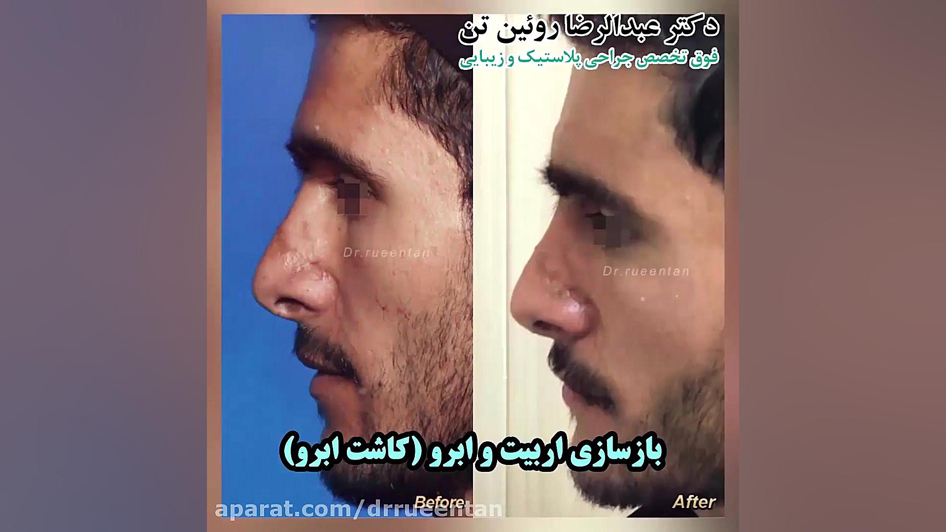 بازسازی اربیت و ابرو (کاشت ابرو) دکتر عبدالرضا روئین تن