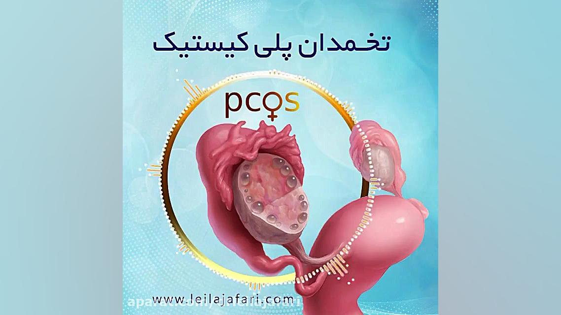 تخمدان پلی کیستیک دکتر لیلا جعفری