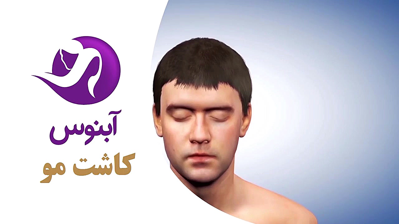 کاشت مو کلینیک آبنوس مشهد کرانیوسینوستوز