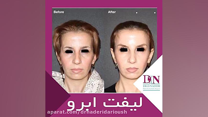 جراحی لیفت ابرو بایوفیزیک پزشکی