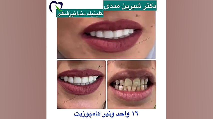 16 واحد کامپوزیت ونیر فک بالا و پایین تست آنتی‌بادی مونوکلونال