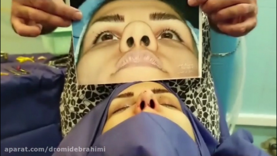 جراحی بینی گوشتی پهن توسط دکتر امید ابراهیمی بهترین جراح بینی دکتر امید ابراهیمی