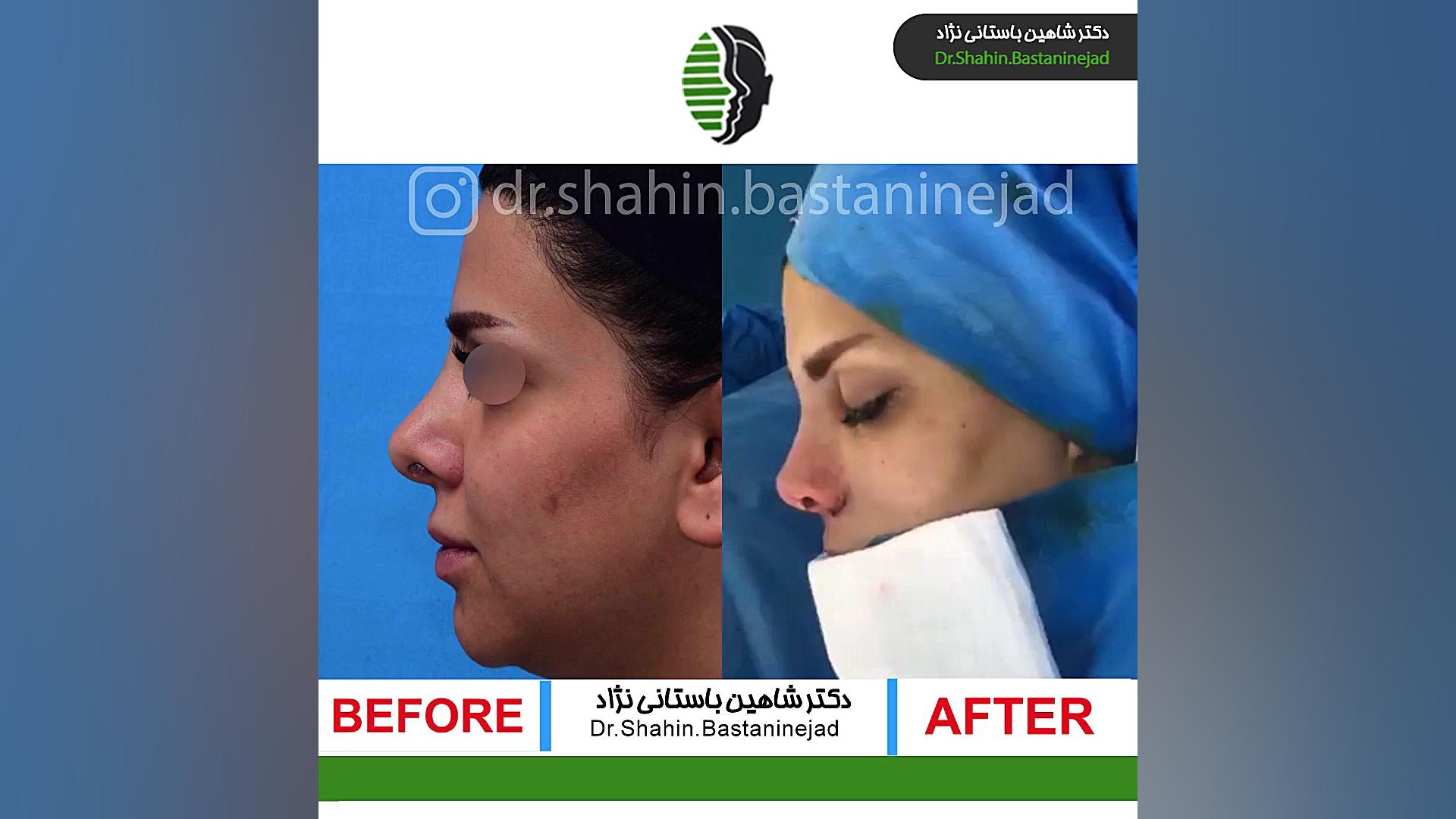 جراحی بینی ترمیمی به فرم نیمه فانتزی ترمیم سوختگی