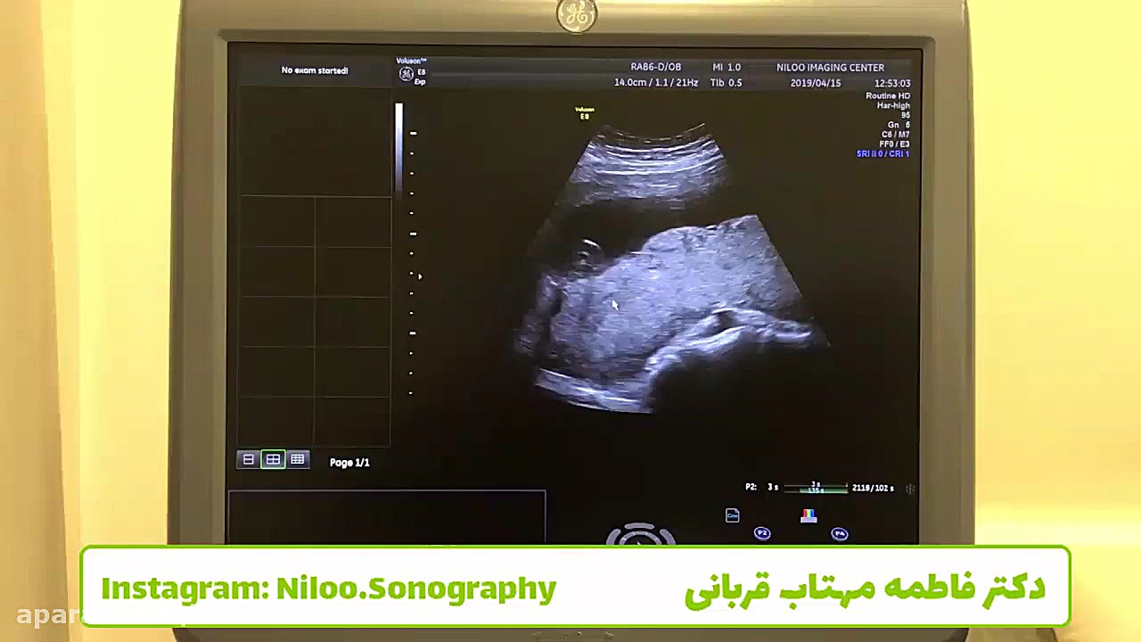 دکولمان جفت - سونوگرافی بارداری لاکپشت رقصان