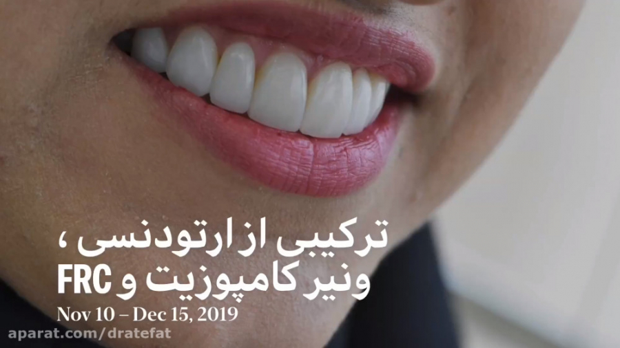 درمان ترکیبی زیبایی دندان و ارتودنسی توسط دکتر عاطفت و دکتر ناصری دکتر محمد عاطفت متخصص ترمیمی و زیبایی اصفهان