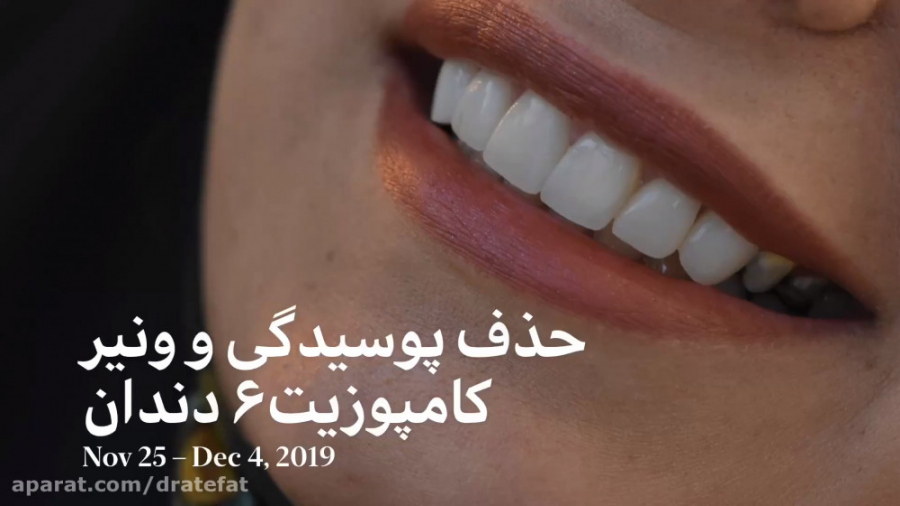 حذف پوسیدگیهای وسیع دندانها، دکتر محمد عاطفت اصفهان دکتر محمد عاطفت متخصص ترمیمی و زیبایی اصفهان