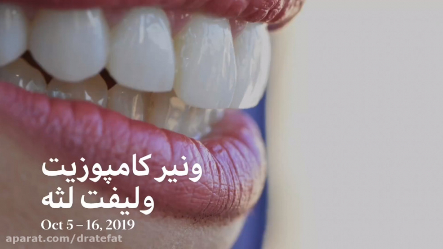 ونیر کامپوزیت دندانهای فک بالا ، متخصص دندانپزشکی ترمیمی زیبایی اصفهان دکتر محمد عاطفت متخصص ترمیمی و زیبایی اصفهان